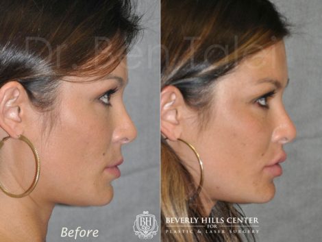 Lip Lift Procedure - Right Side