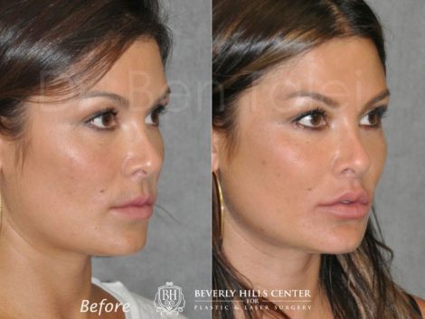 Lip Lift Procedure - Right Side