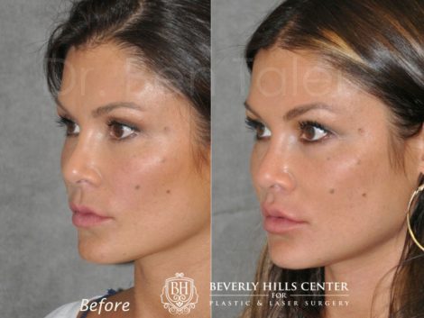 Lip Lift Procedure - Left Side