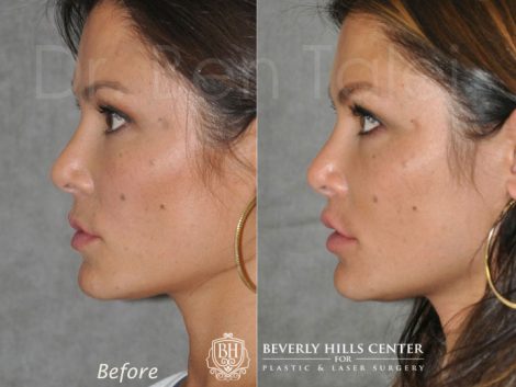Lip Lift Procedure - Left Side