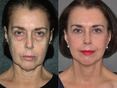 AuraLyft with Eyelid Tightening - Front