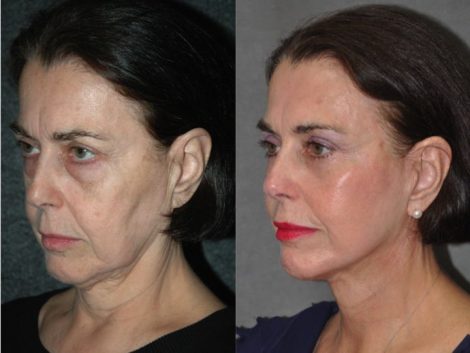 AuraLyft with Eyelid Tightening - Left Side