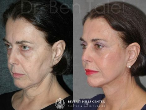 AuraLyft with Eyelid Tightening - Left Side