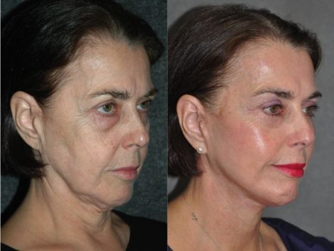 AuraLyft with Eyelid Tightening - Right Side