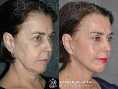 AuraLyft with Eyelid Tightening - Right Side