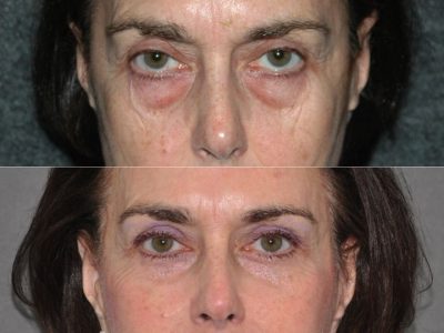 Lower & Upper Eyelid Rejuvenation - Front