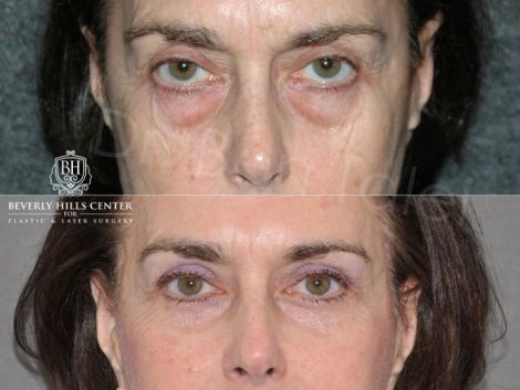 Lower & Upper Eyelid Rejuvenation - Front
