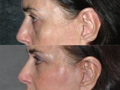 Lower & Upper Eyelid Rejuvenation - Left Side