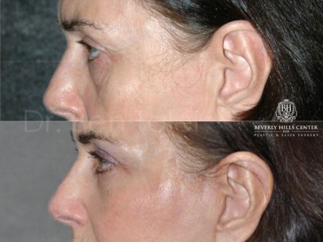 Lower & Upper Eyelid Rejuvenation - Left Side