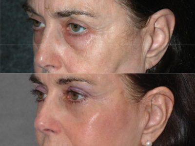 Lower & Upper Eyelid Rejuvenation - Left Side