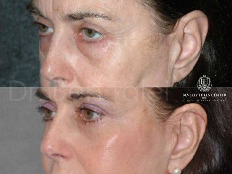 Lower & Upper Eyelid Rejuvenation - Left Side
