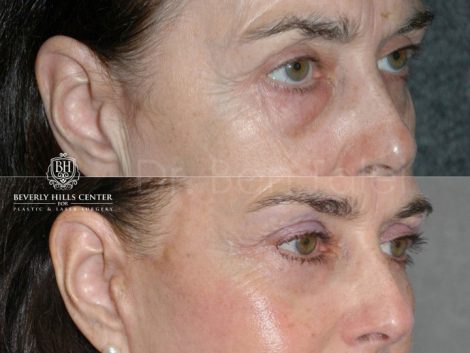 Lower & Upper Eyelid Rejuvenation - Right Side