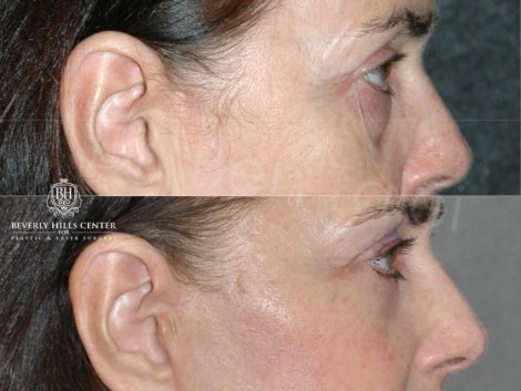 Lower & Upper Eyelid Rejuvenation - Right Side