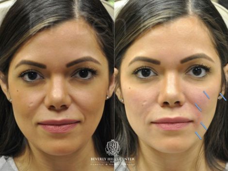 Beverly Hills Center Female Patient Before and After Facial Fillers Procedure