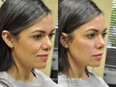 Beverly Hills Center Female Patient Before and After Facial Fillers Procedure