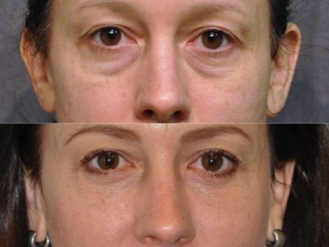 Lower Eyelid Lift - Front