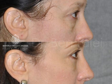 Lower Eyelid Lift - Right Side