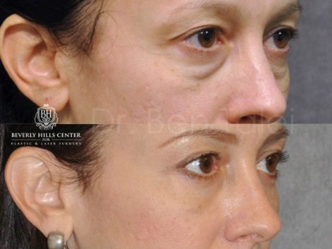 Lower Eyelid Lift - Right Side