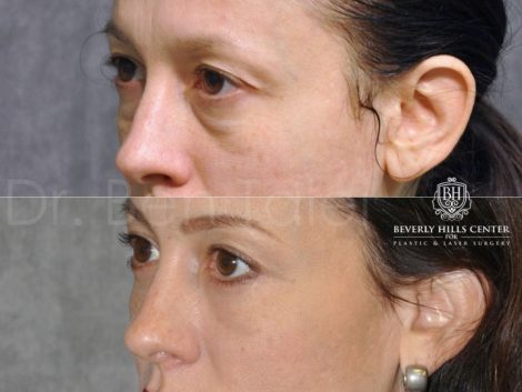 Lower Eyelid Lift - Left Side