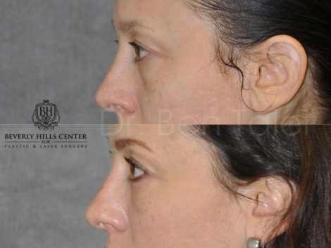Lower Eyelid Lift - Left Side