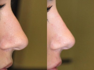 Non Surgical Rhinoplasty