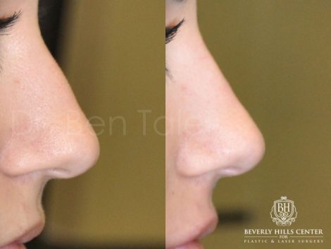 Non Surgical Rhinoplasty