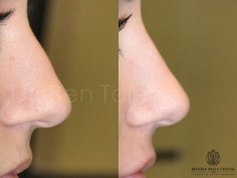 Non Surgical Rhinoplasty