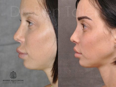 Modified Upper Lip Lift - Left Side