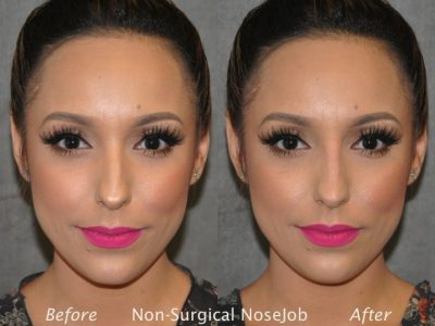 Non Surgical / Liquid Rhinoplasty - Front