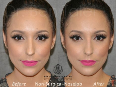 Non Surgical / Liquid Rhinoplasty - Front