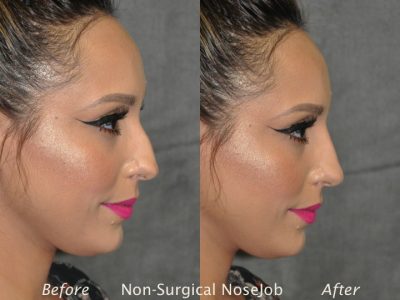 Non Surgical / Liquid Rhinoplasty - Right Side