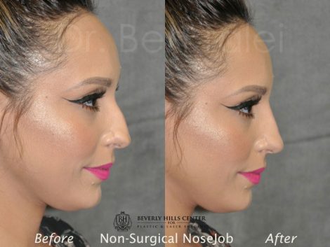 Non Surgical / Liquid Rhinoplasty - Right Side