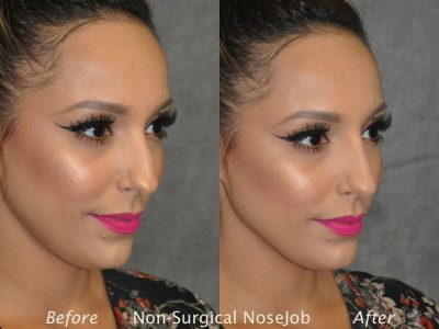 Non Surgical / Liquid Rhinoplasty - Right Side