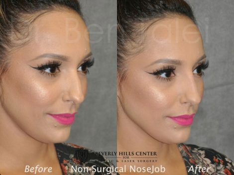 Non Surgical / Liquid Rhinoplasty - Right Side