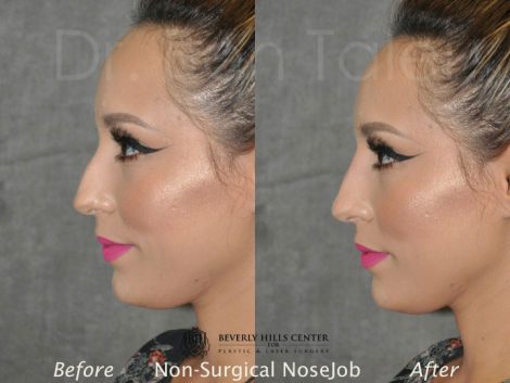Beverly Hills Center Female Patient Before and After Non Surgical Liquid Rhinoplasty