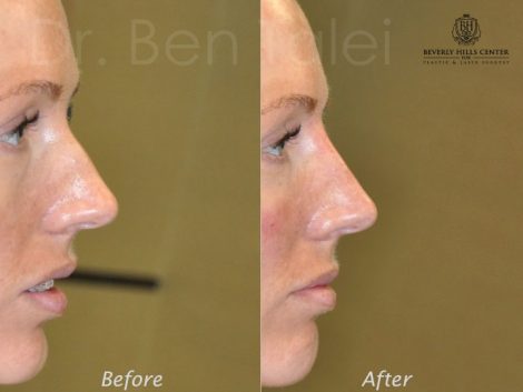 Beverly Hills Center Female Patient Before and After Non-surgical Liquid Rhinoplasty