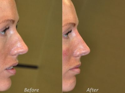 Non Surgical Rhinoplasty / Nosejob - Right Side