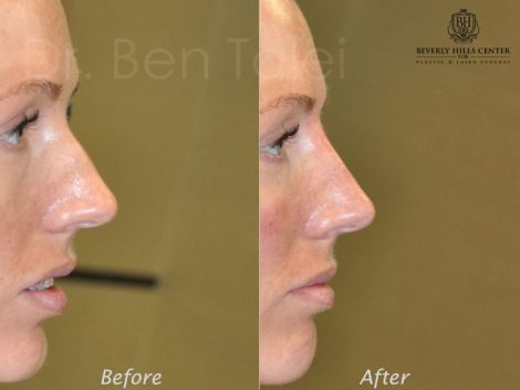 Non Surgical Rhinoplasty / Nosejob - Right Side