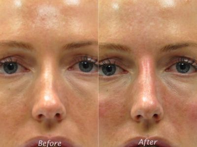 Non Surgical Rhinoplasty / Nosejob