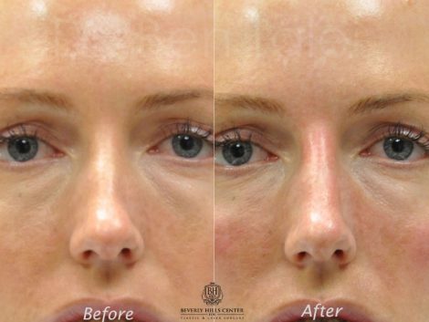 Non Surgical Rhinoplasty / Nosejob