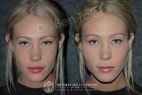 Beverly Hills Center Female Patient Before and After Non-surgical Cheek Procedure