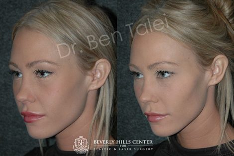 Beverly Hills Center Female Patient Before and After Non-surgical Cheek Procedure