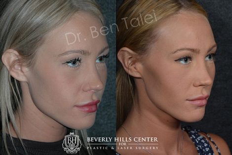 Beverly Hills Center Female Patient Before and After Non-surgical Cheek Procedure