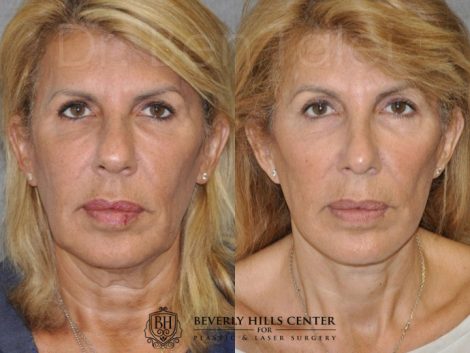 AuraLyft, Lower Eyelid Rejuvenation & Minimally Invasive Rhinoplasty - Front