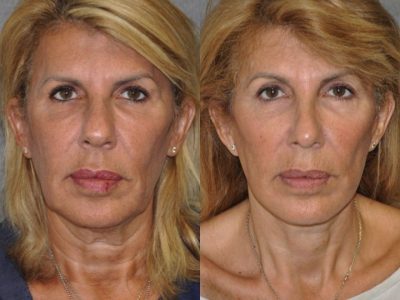 AuraLyft, Lower Eyelid Rejuvenation & Minimally Invasive Rhinoplasty - Front