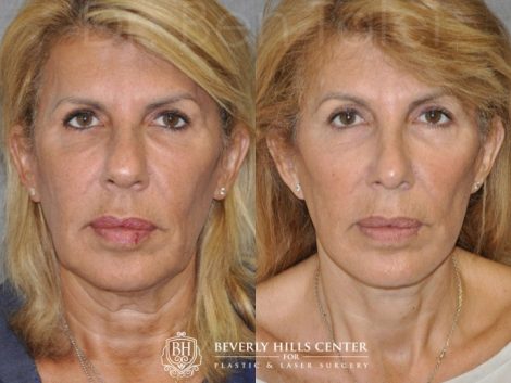 AuraLyft, Lower Eyelid Rejuvenation & Minimally Invasive Rhinoplasty - Front