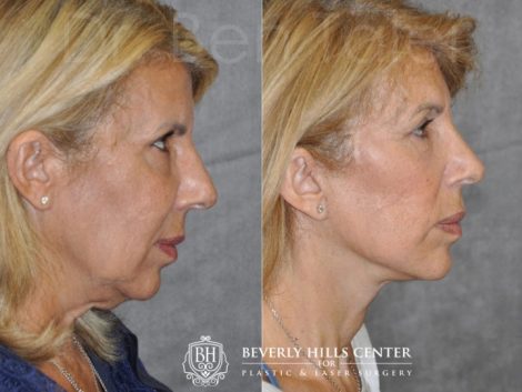 AuraLyft, Lower Eyelid Rejuvenation & Minimally Invasive Rhinoplasty - Right Side