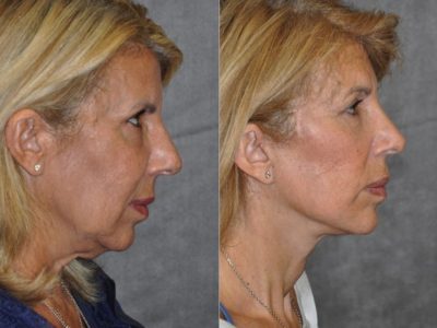 AuraLyft, Lower Eyelid Rejuvenation & Minimally Invasive Rhinoplasty - Right Side