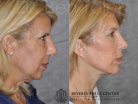 AuraLyft, Lower Eyelid Rejuvenation & Minimally Invasive Rhinoplasty - Right Side
