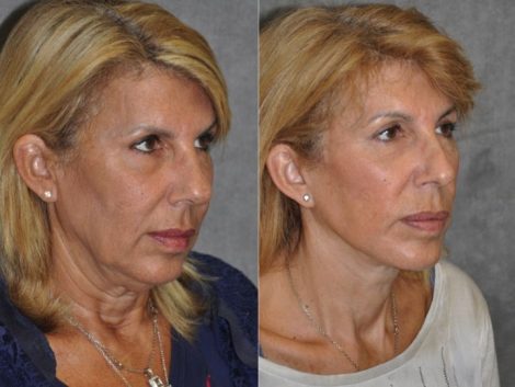 AuraLyft, Lower Eyelid Rejuvenation & Minimally Invasive Rhinoplasty - Right Side